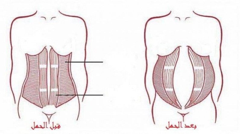 أعراض انفصال البطن بعد الولادة القيصرية